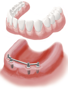 Implantat Teilbezahnung