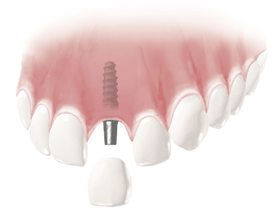 Implantat Frontzahn