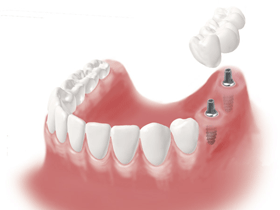 Implantat Seitenzahn